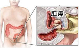 痔疮是什么样的