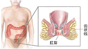 痔疮是什么样的