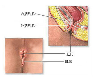 肛裂有哪些症状？