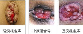 外痔图片、治疗费用