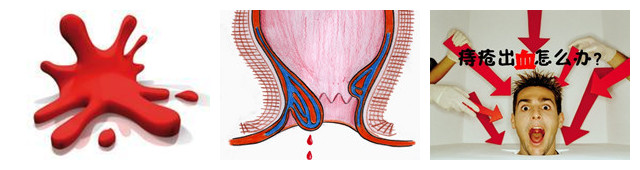痔疮出血